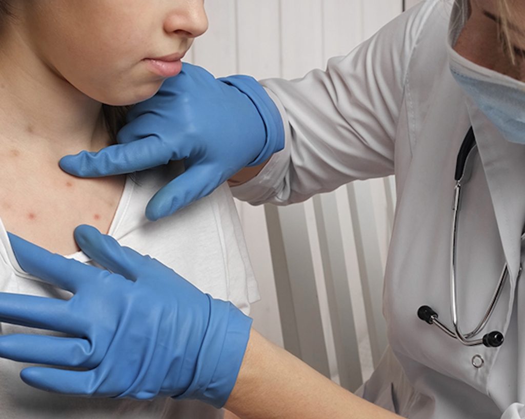 Understanding the Resurgence of Measles: What You Need to Know in 2025