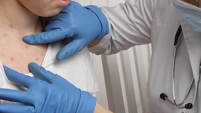 Understanding the Resurgence of Measles: What You Need to Know in 2025